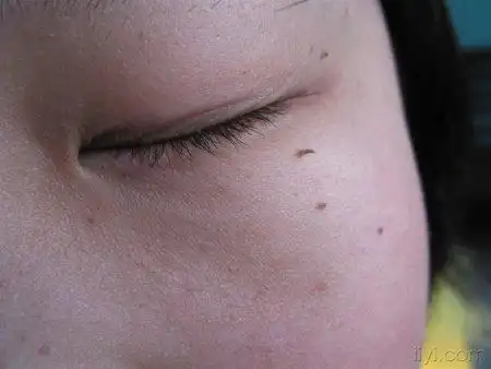 > 丝状疣图    丝状疣是发生于皮肤浅表的外形如丝的小赘生物,俗称