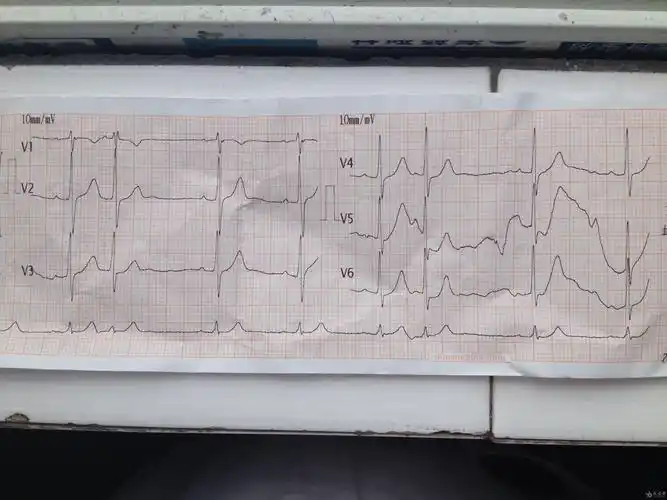 二度二型窦房传导阻滞? - 心电图脑电图专业讨论版 - 爱爱医医学论坛