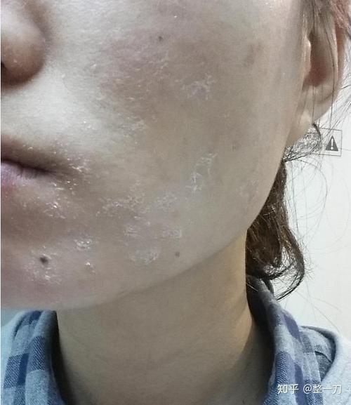 化妆品过敏后的不良症状有哪些呢