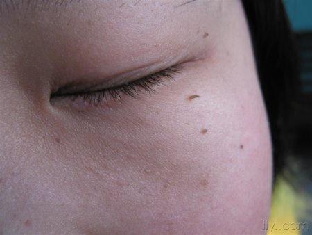 > 丝状疣图    丝状疣是发生于皮肤浅表的外形如丝的小赘生物,俗称