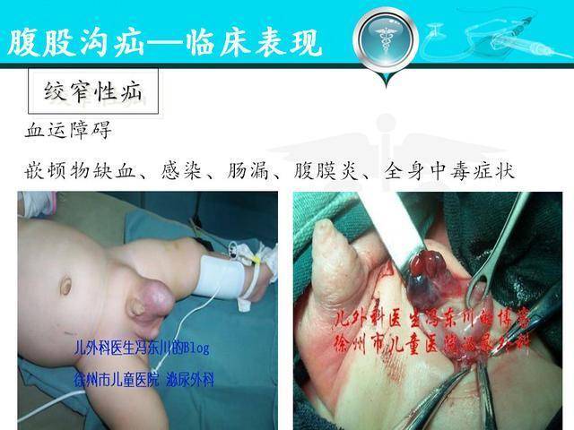 人体腹股沟疝的分型,诊疗