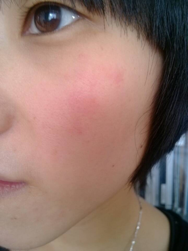 皮肤过敏,发红,发痒,脱皮 ,还有点刺痛 只在两个脸颊上.