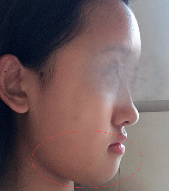 这样的侧面脸型是什么问题为什么我的下巴与嘴之间没有沟