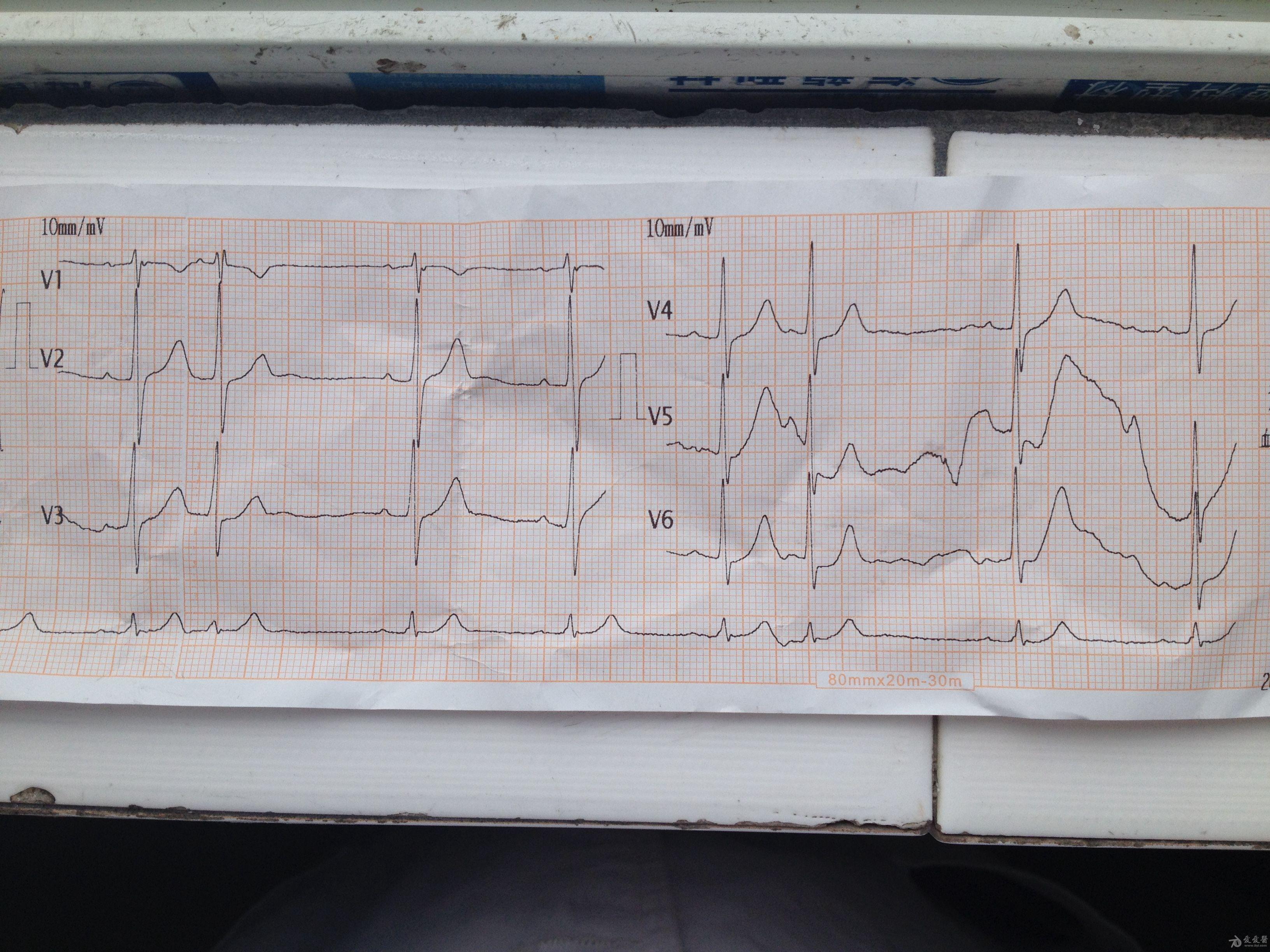 二度二型窦房传导阻滞? - 心电图脑电图专业讨论版 - 爱爱医医学论坛